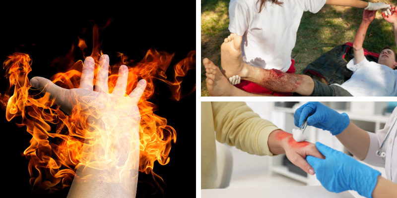 South Carolina Burn Injury Lawyer 