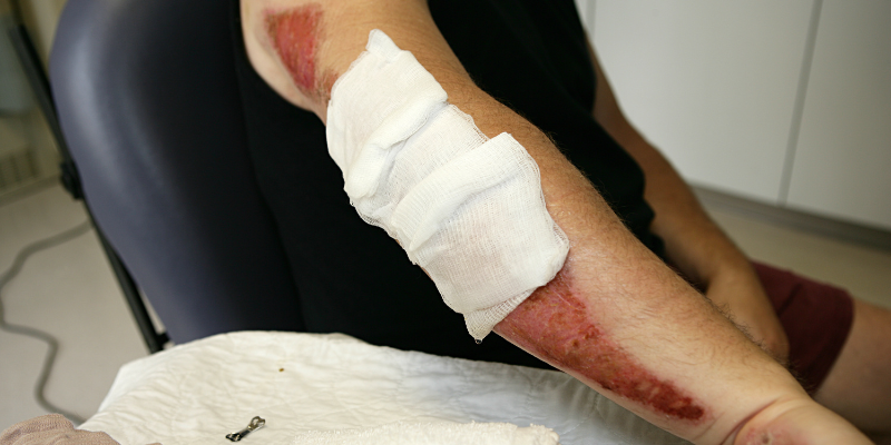 Injured arm with severe road rash and bandages, highlighting the serious injuries motorcycle riders face